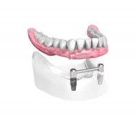 Appareil complet sur 2 implants dentaires – Dentiste Boulogne Billancourt