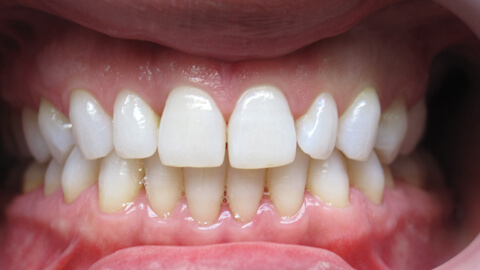 Blanchiment dentaire - Cas Clinique – Dentiste Boulogne Billancourt