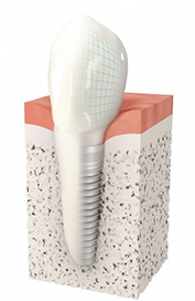 Implant dentaire - Dentiste Boulogne Billancourt