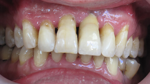 Implant incisive centrale Apres - Cas Clinique – Dentiste Boulogne Billancourt