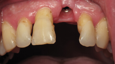 Implant incisive centrale Avant - Cas Clinique – Dentiste Boulogne Billancourt