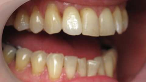 Implant unitaire incisive laterale Apres - Cas Clinique – Dentiste Boulogne Billancourt