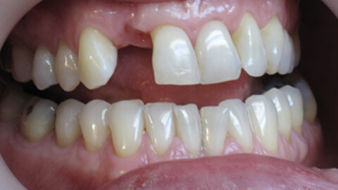 Implant unitaire incisive laterale Avant - Cas Clinique – Dentiste Boulogne Billancourt