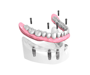 Mise en place des implants dentaires - Dentiste Boulogne Billancourt
