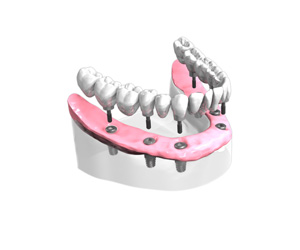 Pose d un bridge complet sur implants dentaires All-on-6 – Dentiste Boulogne Billancourt