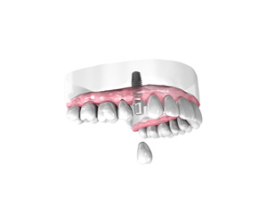 Pose d une couronne dentaire sur implant - Dentiste Boulogne Billancourt