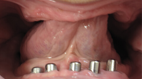 Prothese amovible complete Avant - Cas clinique – Dentiste Boulogne Billancourt