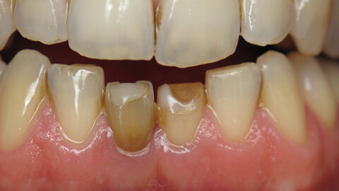 Reconstruction incisives mandibulaires Avant - Cas Clinique – Dentiste Boulogne Billancourt