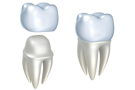 couronne-dentaire - Dentiste Boulogne Billancourt
